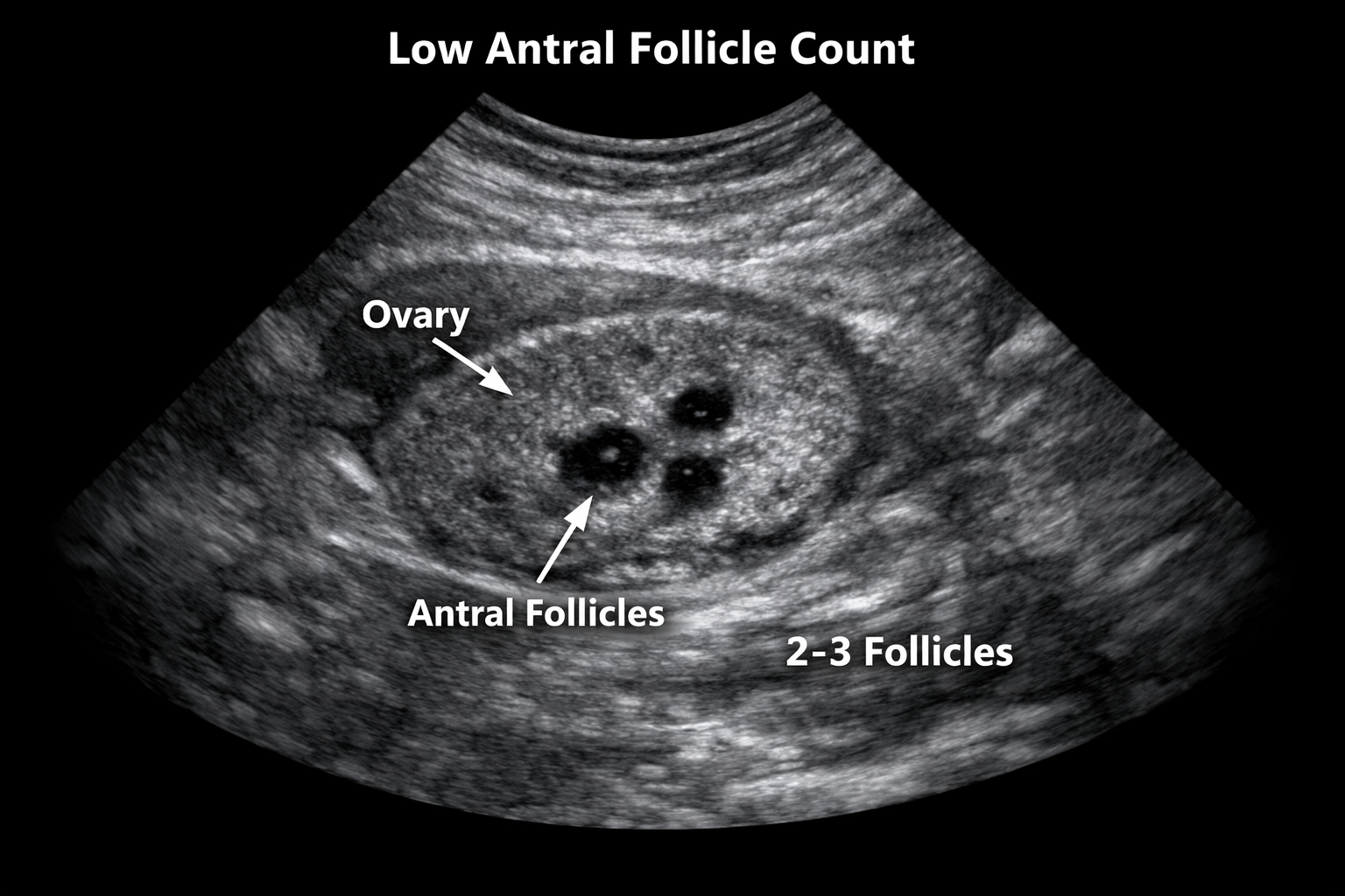 You are currently viewing Busting the Myth: “Low AMH Means No Chance of Pregnancy”